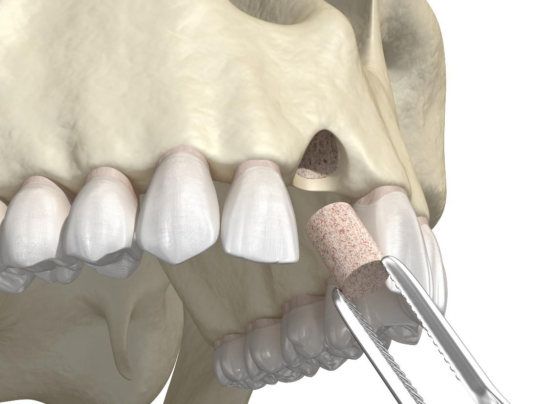 Bone Grafting Bellevue, WA