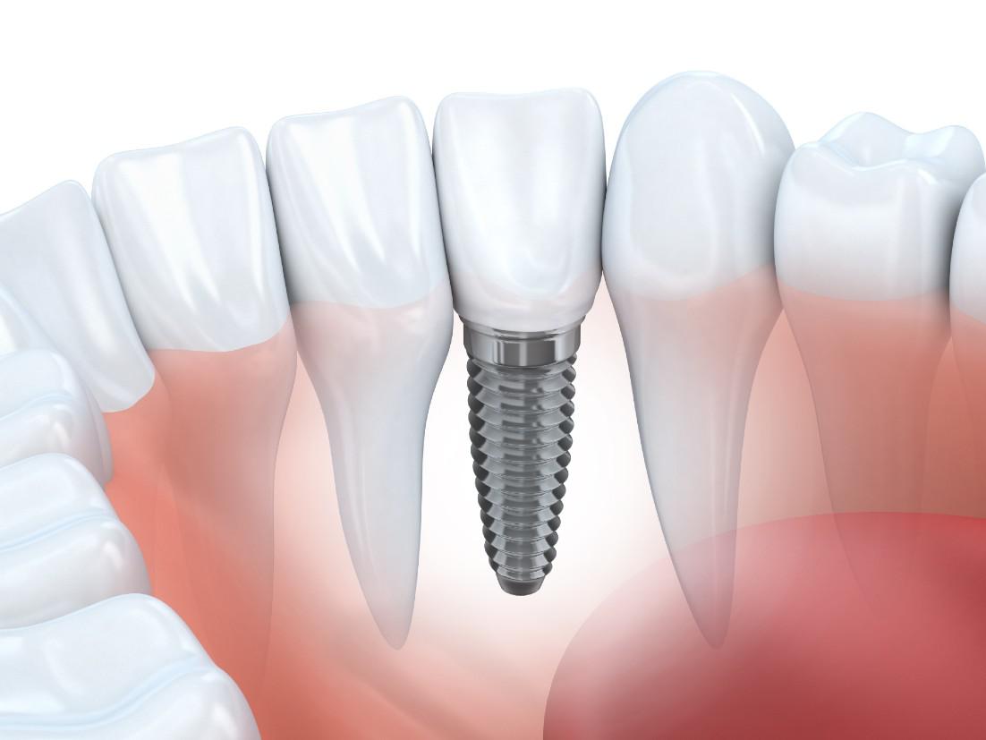 Dental Implants Bellevue, WA